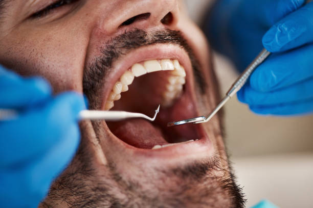 Best Emergency Root Canal Treatment in Centerville, OH